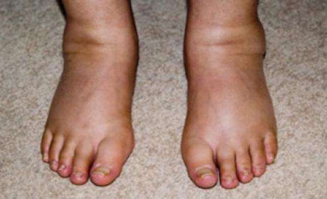 Ibimenyetso 4 ushobora kurebera ku birenge byawe ukamenya ko urwaye umwijima