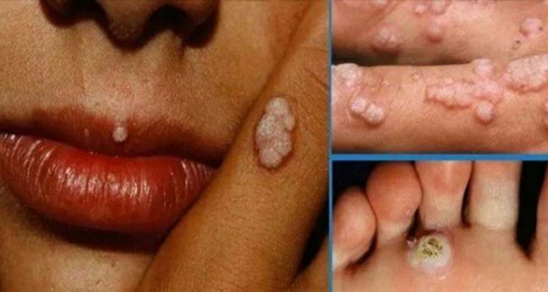 Niba ujya ukoresha ururimi cyangwa watekerezaga kuzabikora urarye uri menge😭 Ibyo wamenya ku ndwara bahimba chou-fleur, iterwa na HPV, ikibasira cyane abakoresha ururimi mu gutera akabariro.