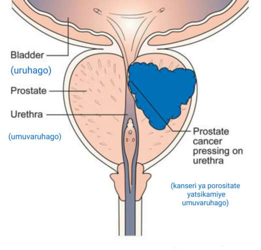 Niba ukora ibi menya ko urimo kwiyongerera ibyago byo kurwara Kanseri ya Prostate(Kanseri y'Amabya)