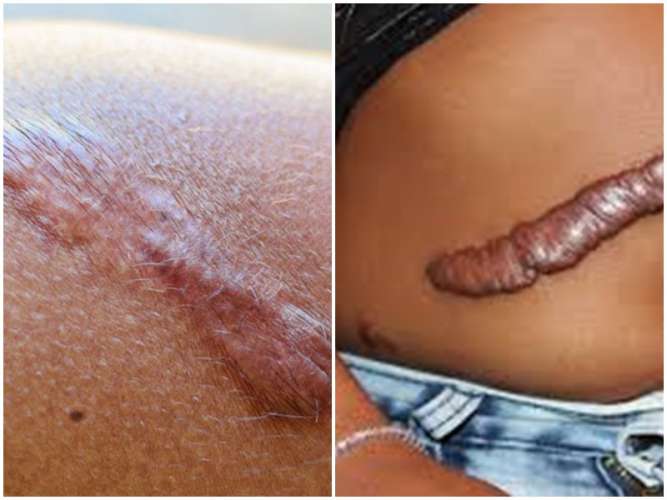 Dore uko wakira inkovu zibyimba mu minsi 7 gusa