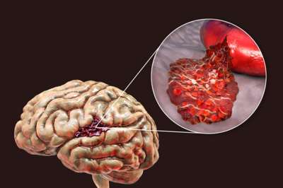 Dore ibintu byoroshye wakora ukaba wirinze indwara z&rsquo;umutima na Stroke