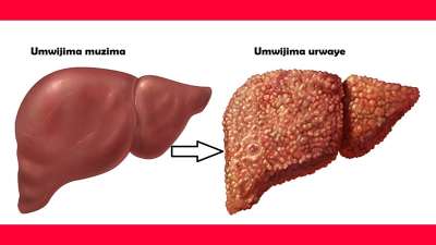 Wabwirwa n&rsquo;iki ko urwaye indwara y&rsquo;umwijima? Sobanukirwa