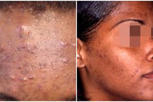 Umuti w'ibiheri byo mu maso