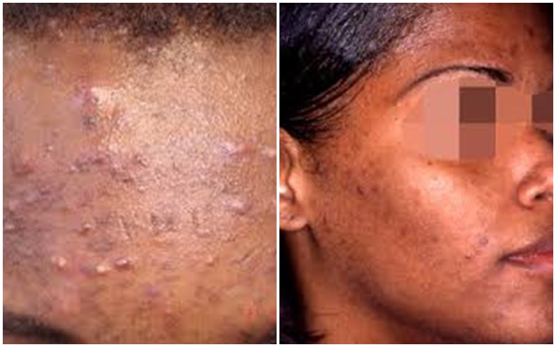 Umuti w'ibiheri byo mu maso