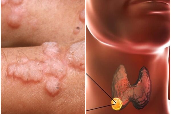 Biryoha biryana! Dore indwara karahabutaka zigutegereje niba ujya urigata igitsina cy’umugore cyangwa umugabo