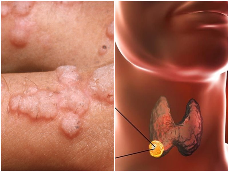 Indwara iterwa no konka igitsina