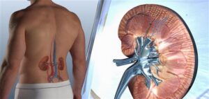 Ujya ubyimba ibirenge, umunaniro cyangwa kumva ukonje cyane mu mubiri? Menya ibimenyetso 10 byakwereka ko urwaye impyiko