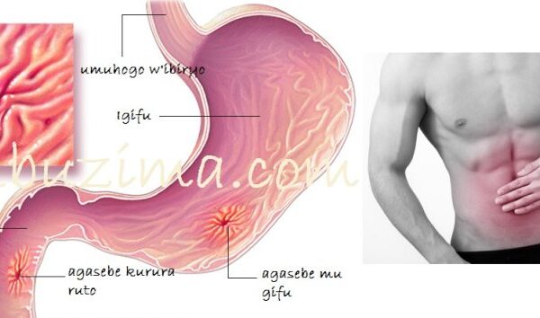 Sobanukirwa indwara ya Kanseri y’igifu, ibimenyetso byayo n’uko wayirinda