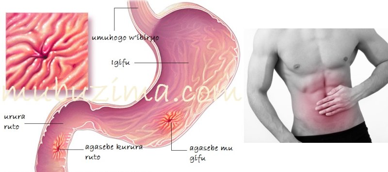 Sobanukirwa indwara ya Kanseri y’igifu, ibimenyetso byayo n’uko wayirinda