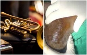 Ese koko kuvuza imyirongi byaba biri mu bitera indwara y’imisuha? Sobanukirwa byinshi kuri iyi ndwara