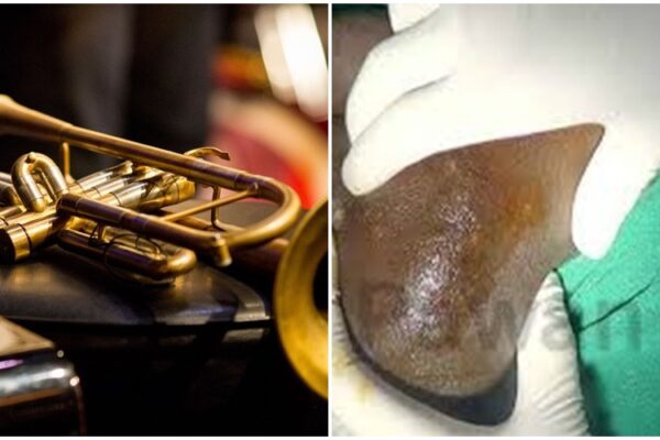 Ese koko kuvuza imyirongi byaba biri mu bitera indwara y’imisuha? Sobanukirwa byinshi kuri iyi ndwara