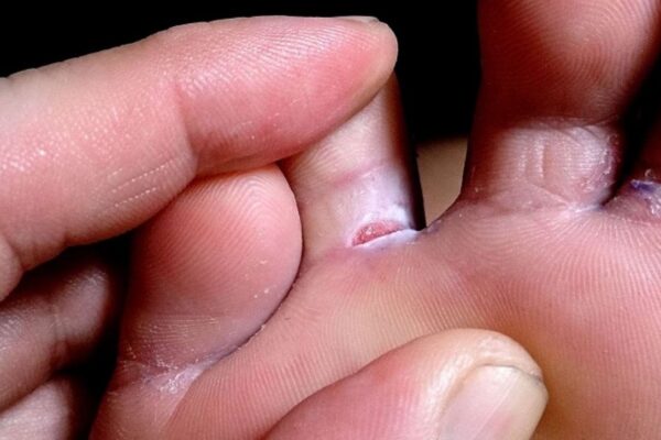 Menya byinshi ku ndwara y’ibimeme, uko byandura n’uko bivurwa