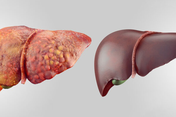 Ibimenyetso byakwereka ko umwijima wawe uri kwangirika n’ibyo wakora mu kuwurinda